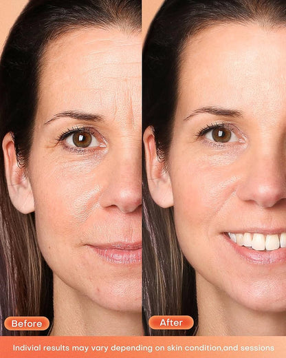 Zyllo™ Therapy Mask